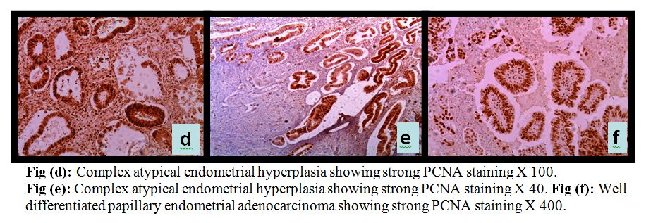 The value of PTEN, PCNA and B-Catenin to differentiate between endometrial hyperplasia and endometrial adenocarcinoma